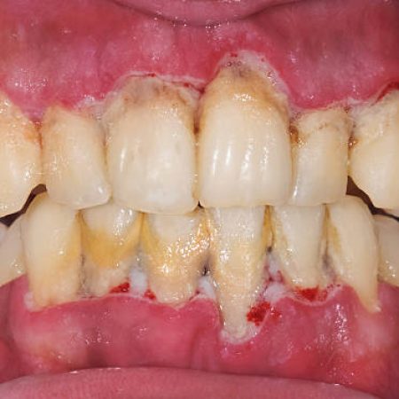 Human teeth with periodontitis.There's a heavy calculus deposite, gum swelling, chronic inflammation,gingival recession,teeth missing and stain. Selective focus.You can find more dental related images like this one here :